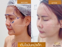 S__109551717.jpg - เติมไขมันหน้าเด็ก | https://ptinfinity.com
