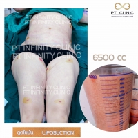 S__112590992.jpg - ดูดไขมัน แผลเล็กมาก เจ็บน้อย ชิวชิว ไม่ต้องวางยา | https://ptinfinity.com