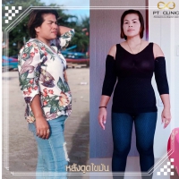 S__131678320.jpg - ดูดไขมัน แผลเล็กมาก เจ็บน้อย ชิวชิว ไม่ต้องวางยา | https://ptinfinity.com