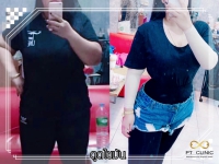 S__131678321.jpg - ดูดไขมัน แผลเล็กมาก เจ็บน้อย ชิวชิว ไม่ต้องวางยา | https://ptinfinity.com