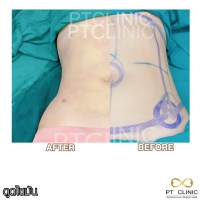 S__131678323.jpg - ดูดไขมัน แผลเล็กมาก เจ็บน้อย ชิวชิว ไม่ต้องวางยา | https://ptinfinity.com