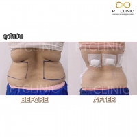 S__131678324.jpg - ดูดไขมัน แผลเล็กมาก เจ็บน้อย ชิวชิว ไม่ต้องวางยา | https://ptinfinity.com