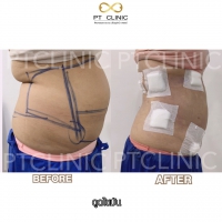 S__131678325.jpg - ดูดไขมัน แผลเล็กมาก เจ็บน้อย ชิวชิว ไม่ต้องวางยา | https://ptinfinity.com