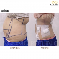 S__131678327.jpg - ดูดไขมัน แผลเล็กมาก เจ็บน้อย ชิวชิว ไม่ต้องวางยา | https://ptinfinity.com