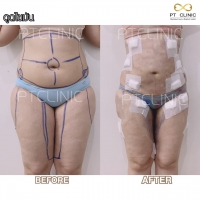 S__131678328.jpg - ดูดไขมัน แผลเล็กมาก เจ็บน้อย ชิวชิว ไม่ต้องวางยา | https://ptinfinity.com