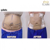 S__131678329.jpg - ดูดไขมัน แผลเล็กมาก เจ็บน้อย ชิวชิว ไม่ต้องวางยา | https://ptinfinity.com