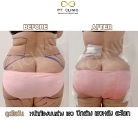 S__131678330.jpg - ดูดไขมัน แผลเล็กมาก เจ็บน้อย ชิวชิว ไม่ต้องวางยา | https://ptinfinity.com