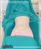 S__131678331.jpg - ดูดไขมัน แผลเล็กมาก เจ็บน้อย ชิวชิว ไม่ต้องวางยา | https://ptinfinity.com