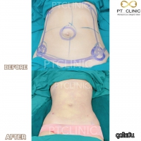 S__131678332.jpg - ดูดไขมัน แผลเล็กมาก เจ็บน้อย ชิวชิว ไม่ต้องวางยา | https://ptinfinity.com