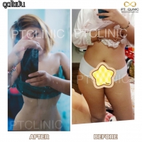 S__131678334.jpg - ดูดไขมัน แผลเล็กมาก เจ็บน้อย ชิวชิว ไม่ต้องวางยา | https://ptinfinity.com