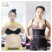 S__131678336.jpg - ดูดไขมัน แผลเล็กมาก เจ็บน้อย ชิวชิว ไม่ต้องวางยา | https://ptinfinity.com