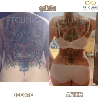 S__131678342.jpg - ดูดไขมัน แผลเล็กมาก เจ็บน้อย ชิวชิว ไม่ต้องวางยา | https://ptinfinity.com