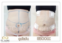 S__131678459.jpg - ดูดไขมัน แผลเล็กมาก เจ็บน้อย ชิวชิว ไม่ต้องวางยา | https://ptinfinity.com