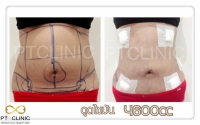 S__131678461.jpg - ดูดไขมัน แผลเล็กมาก เจ็บน้อย ชิวชิว ไม่ต้องวางยา | https://ptinfinity.com