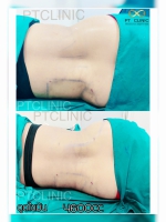 S__131678462.jpg - ดูดไขมัน แผลเล็กมาก เจ็บน้อย ชิวชิว ไม่ต้องวางยา | https://ptinfinity.com