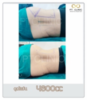 S__131678463.jpg - ดูดไขมัน แผลเล็กมาก เจ็บน้อย ชิวชิว ไม่ต้องวางยา | https://ptinfinity.com