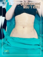 S__131678464.jpg - ดูดไขมัน แผลเล็กมาก เจ็บน้อย ชิวชิว ไม่ต้องวางยา | https://ptinfinity.com