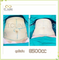 S__131678465.jpg - ดูดไขมัน แผลเล็กมาก เจ็บน้อย ชิวชิว ไม่ต้องวางยา | https://ptinfinity.com