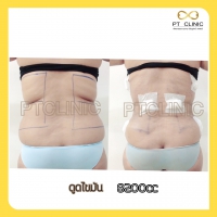 S__131678468.jpg - ดูดไขมัน แผลเล็กมาก เจ็บน้อย ชิวชิว ไม่ต้องวางยา | https://ptinfinity.com