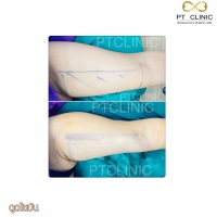 S__131678469.jpg - ดูดไขมัน แผลเล็กมาก เจ็บน้อย ชิวชิว ไม่ต้องวางยา | https://ptinfinity.com