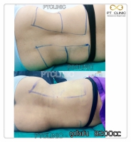 S__131678470.jpg - ดูดไขมัน แผลเล็กมาก เจ็บน้อย ชิวชิว ไม่ต้องวางยา | https://ptinfinity.com