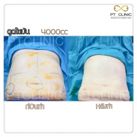 S__131678472.jpg - ดูดไขมัน แผลเล็กมาก เจ็บน้อย ชิวชิว ไม่ต้องวางยา | https://ptinfinity.com