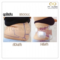 S__131678473.jpg - ดูดไขมัน แผลเล็กมาก เจ็บน้อย ชิวชิว ไม่ต้องวางยา | https://ptinfinity.com