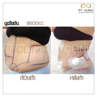 S__131678474.jpg - ดูดไขมัน แผลเล็กมาก เจ็บน้อย ชิวชิว ไม่ต้องวางยา | https://ptinfinity.com