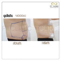 S__131678475.jpg - ดูดไขมัน แผลเล็กมาก เจ็บน้อย ชิวชิว ไม่ต้องวางยา | https://ptinfinity.com