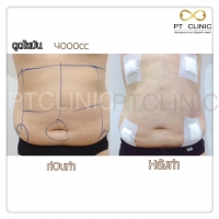 S__131678476.jpg - ดูดไขมัน แผลเล็กมาก เจ็บน้อย ชิวชิว ไม่ต้องวางยา | https://ptinfinity.com