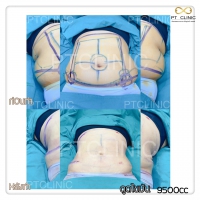 S__131678477.jpg - ดูดไขมัน แผลเล็กมาก เจ็บน้อย ชิวชิว ไม่ต้องวางยา | https://ptinfinity.com