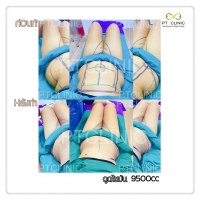 S__131678478.jpg - ดูดไขมัน แผลเล็กมาก เจ็บน้อย ชิวชิว ไม่ต้องวางยา | https://ptinfinity.com