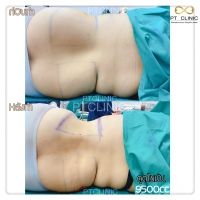 S__131678479.jpg - ดูดไขมัน แผลเล็กมาก เจ็บน้อย ชิวชิว ไม่ต้องวางยา | https://ptinfinity.com