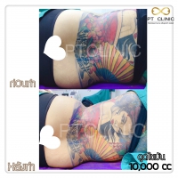 S__131678481.jpg - ดูดไขมัน แผลเล็กมาก เจ็บน้อย ชิวชิว ไม่ต้องวางยา | https://ptinfinity.com