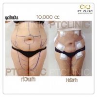 S__131678483.jpg - ดูดไขมัน แผลเล็กมาก เจ็บน้อย ชิวชิว ไม่ต้องวางยา | https://ptinfinity.com