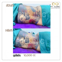 S__131678485.jpg - ดูดไขมัน แผลเล็กมาก เจ็บน้อย ชิวชิว ไม่ต้องวางยา | https://ptinfinity.com