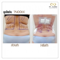 S__131678486.jpg - ดูดไขมัน แผลเล็กมาก เจ็บน้อย ชิวชิว ไม่ต้องวางยา | https://ptinfinity.com