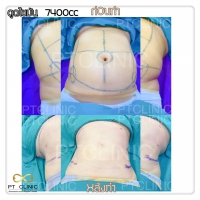 S__131678488.jpg - ดูดไขมัน แผลเล็กมาก เจ็บน้อย ชิวชิว ไม่ต้องวางยา | https://ptinfinity.com