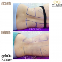 S__131678489.jpg - ดูดไขมัน แผลเล็กมาก เจ็บน้อย ชิวชิว ไม่ต้องวางยา | https://ptinfinity.com