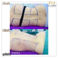 S__131678490.jpg - ดูดไขมัน แผลเล็กมาก เจ็บน้อย ชิวชิว ไม่ต้องวางยา | https://ptinfinity.com