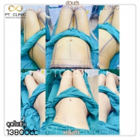 S__131678491.jpg - ดูดไขมัน แผลเล็กมาก เจ็บน้อย ชิวชิว ไม่ต้องวางยา | https://ptinfinity.com