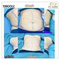 S__131678492.jpg - ดูดไขมัน แผลเล็กมาก เจ็บน้อย ชิวชิว ไม่ต้องวางยา | https://ptinfinity.com