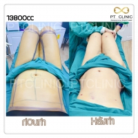 S__131678494.jpg - ดูดไขมัน แผลเล็กมาก เจ็บน้อย ชิวชิว ไม่ต้องวางยา | https://ptinfinity.com