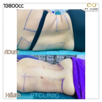 S__131678495.jpg - ดูดไขมัน แผลเล็กมาก เจ็บน้อย ชิวชิว ไม่ต้องวางยา | https://ptinfinity.com