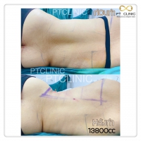 S__131678496.jpg - ดูดไขมัน แผลเล็กมาก เจ็บน้อย ชิวชิว ไม่ต้องวางยา | https://ptinfinity.com