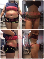 S__131678497.jpg - ดูดไขมัน แผลเล็กมาก เจ็บน้อย ชิวชิว ไม่ต้องวางยา | https://ptinfinity.com