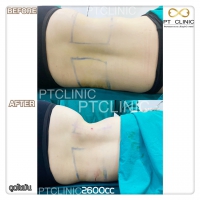 S__131678498.jpg - ดูดไขมัน แผลเล็กมาก เจ็บน้อย ชิวชิว ไม่ต้องวางยา | https://ptinfinity.com