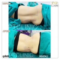 S__131678499.jpg - ดูดไขมัน แผลเล็กมาก เจ็บน้อย ชิวชิว ไม่ต้องวางยา | https://ptinfinity.com