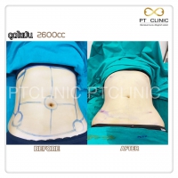 S__131678500.jpg - ดูดไขมัน แผลเล็กมาก เจ็บน้อย ชิวชิว ไม่ต้องวางยา | https://ptinfinity.com