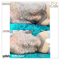 S__131678502.jpg - ดูดไขมัน แผลเล็กมาก เจ็บน้อย ชิวชิว ไม่ต้องวางยา | https://ptinfinity.com